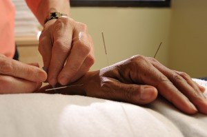 Acupuncture-hand